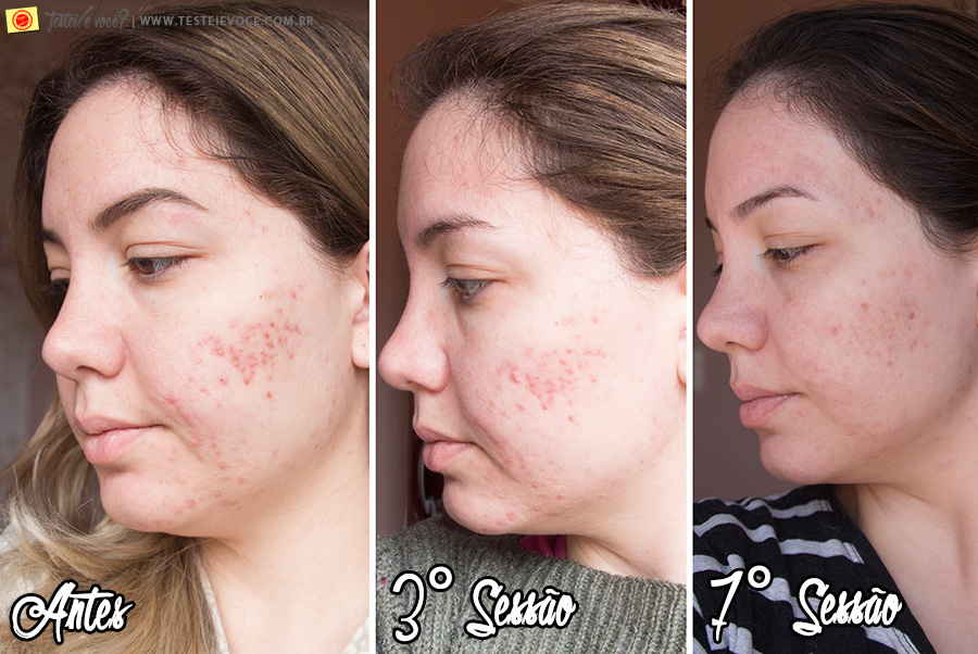Tratamento para Acne com Equipamentos HTM Eletrônica Tratamento para Acne com Equipamentos HTM Eletrônica