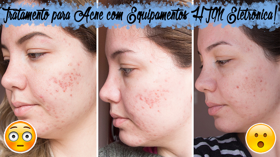Tratamento para Acne com Equipamentos HTM Eletrônica Tratamento para Acne com Equipamentos HTM Eletrônica